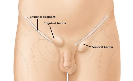 Femoral hernia - Groin swellings