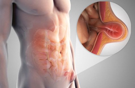 Reducible swelling of the inguinal region