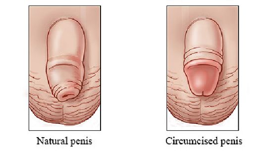 circumcised men