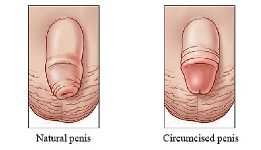 circumcised versus not circumcised