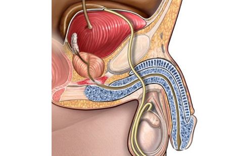 Prostate Enlargement Treatment Singapore Advanced Urology