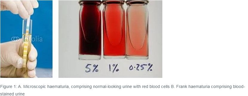 blood-in-urine-3-reasons-why-it-could-happen-sitaram-bhartia-blog