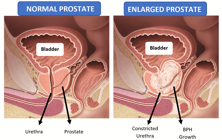 Normal and Enlarged Prostate