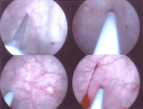 Intravesical injection of Botulinum toxin